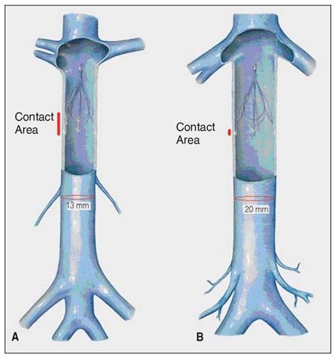 Side Effects of Blood Clot Filters | by Thomas J Matthew | Medium