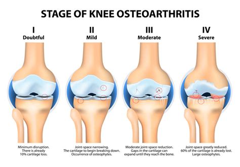 Post-Op Knee Replacement Surgery Physiotherapy Services Mississauga & Etobicoke | PhysioNow