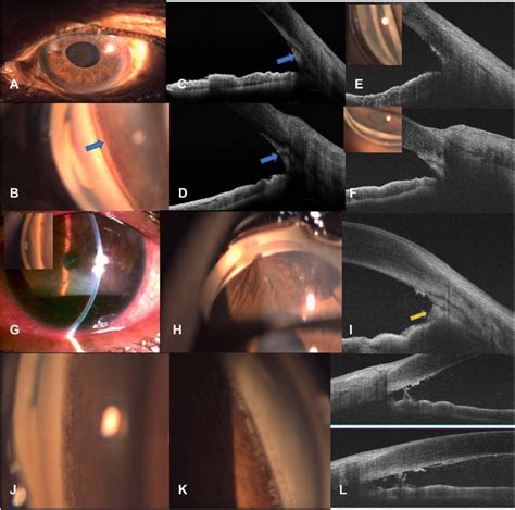 (A-D) show a pseudophakic patient with pseudoexfoliation glaucoma that... | Download Scientific ...