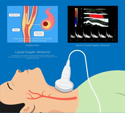 Carotid Artery Stent Specialist - New Port Richey, FL: Satish ...