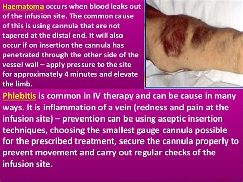 IV CANNULA INSERTION