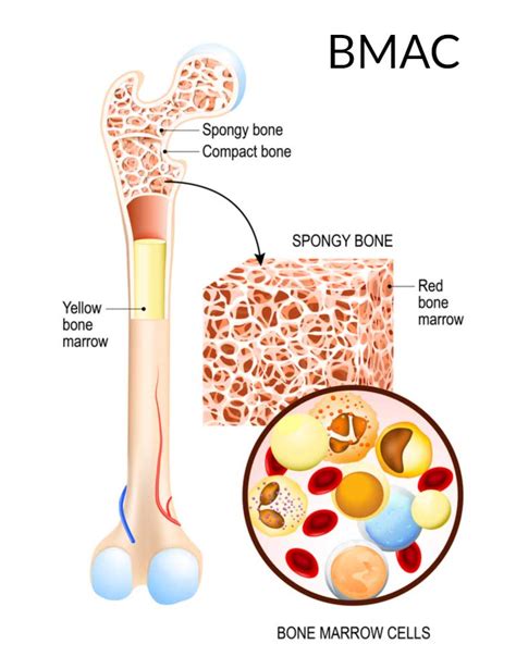 Stem Cells | Bone Marrow Aspirate Concentrate | BMAC | Orthopedic Surgeon | Manhattan, Brooklyn ...