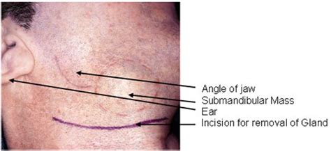 Head & Neck Surgery – Salivary Gland Surgery