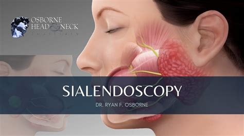 Sialendoscopy Procedure for Parotid Gland Stones, Explained By Dr. Ryan ...