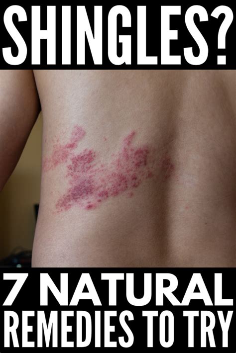 Natural Remedies for Shingles: 7 Home Treatments that Help