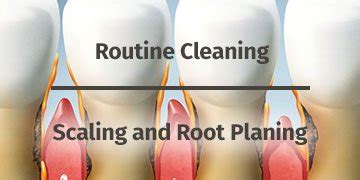 Periodontal Scaling and Root Planing | SRP SRPs | Pasadena TX