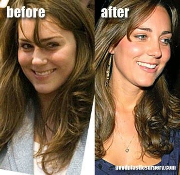 Celebrity: Kate Middleton Had Plastic Surgery | The Glitter