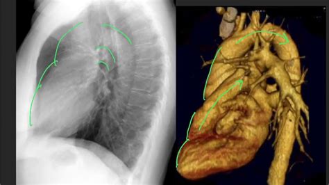 Anatomy on the lateral CXR - YouTube