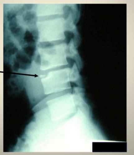 Lumbar Spine Pathology Part II Flashcards | Quizlet