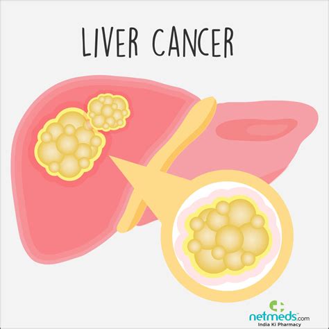 Liver Cancer: Causes, Symptoms And Treatment