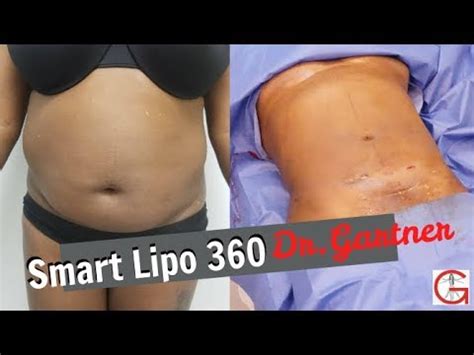 Smart Lipo 360| Liposuction| Before and After| Dr. Gartner| Gartner ...