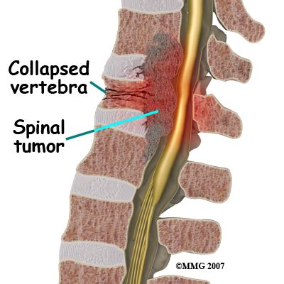 TUMOR VERTEBRAL - Cirugia de Columna en Matamoros