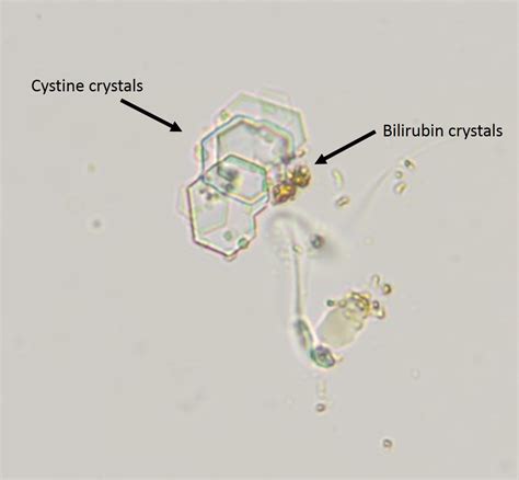 Figure 2a: Urine sediment from a dog with cystine urolithiasis | eClinpath