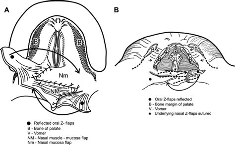 Primary Palatoplasty: Double-Opposing Z-Plasty (Furlow Technique) | Pocket Dentistry