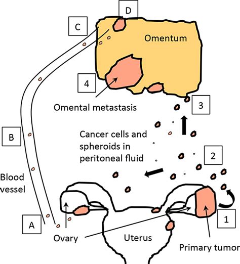 Ovarian Cancer Metastasis: A Unique Mechanism of Dissemination | IntechOpen