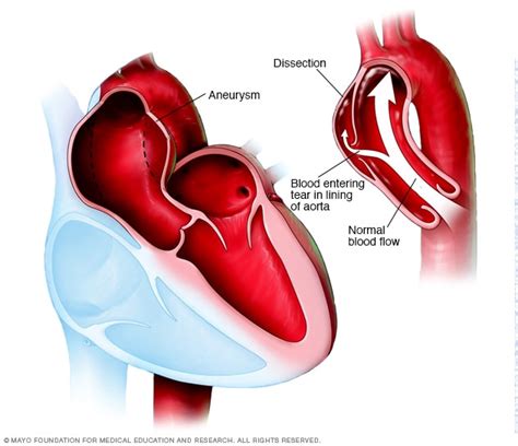 Marfan Syndrome Heart