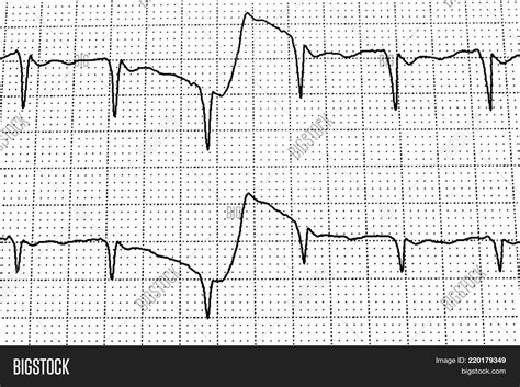 Electrocardiogram Test Image & Photo (Free Trial) | Bigstock