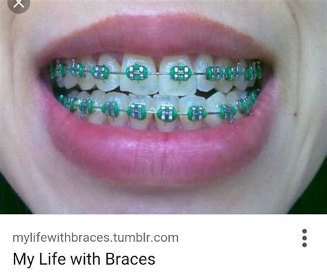 Green braces | Dental braces colors, Green braces, Braces colors