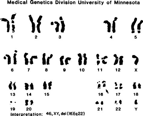 Figure 1 from Partial deletion of the long arm of chromosome 16 and ...