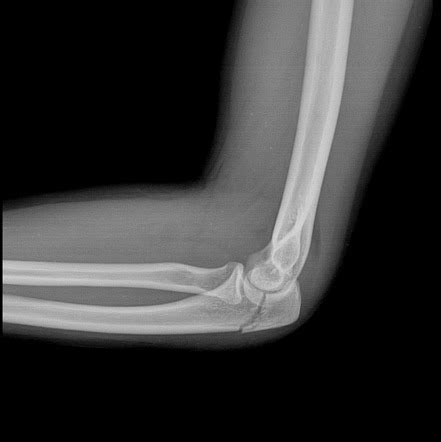 Elbow X Ray Fracture