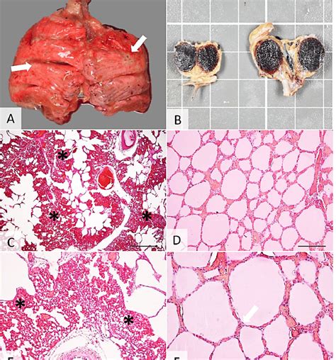 Ascites Syndrome in a Brahma Chicken. Image A: Diffuse lung congestion ...