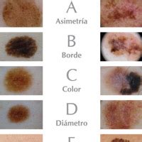 ABCDE del Melanoma | HC Marbella International Hospital