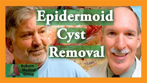 Epidermoid Cyst Removal INTACT| Auburn Medical Group - YouTube