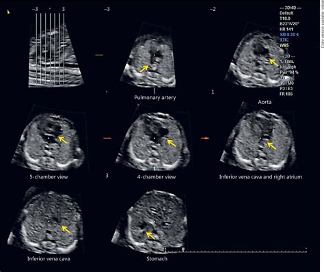 Figure 8 from Early Evaluation of the Fetal Heart. - Semantic Scholar