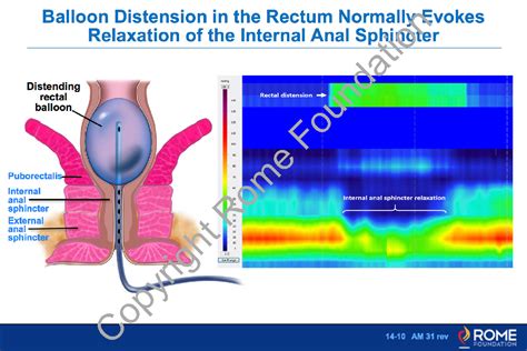 Anorectal 10 – Balloon Distension in the Rectum Normally Evokes ...