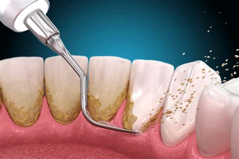 Limpiezas Dentales Ultrasónicas