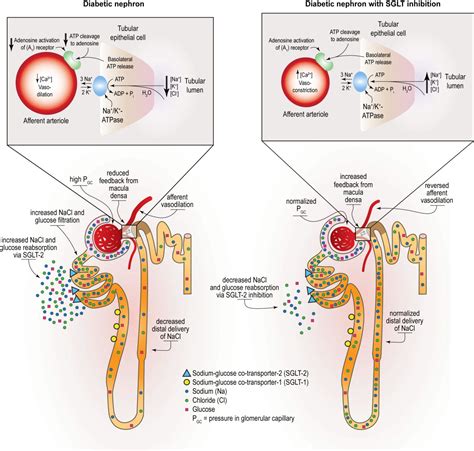 SGLT2 Inhibitors and Adverse Events: A Closer Look – AJKD Blog