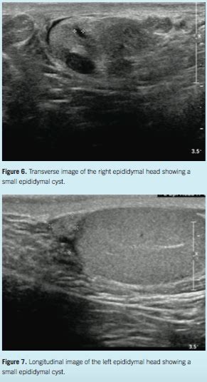 Testicular Cyst Ultrasound