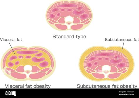 Subcutaneous fat hi-res stock photography and images - Alamy