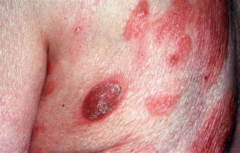 Mycosis Fungoides - Huidarts.com