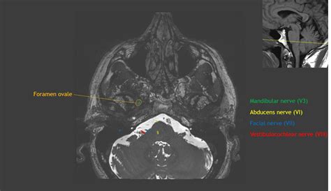 CaseStacks.com - Cranial Nerve Anatomy on MRI