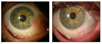 Pterygium Surgical Treatment - Medical & Surgical Vision Care, Inc