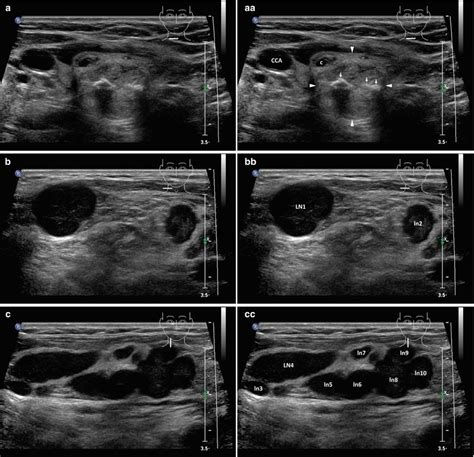 Other Malignancies in Thyroid Gland and Cervical Lymph Nodes ...