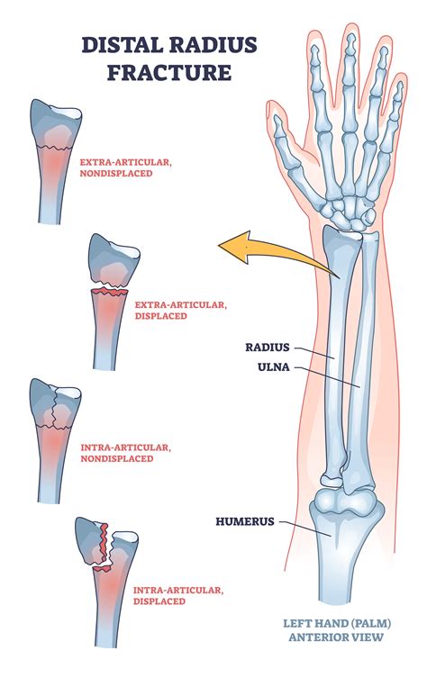 Distal Radius Fracture: What Is It?