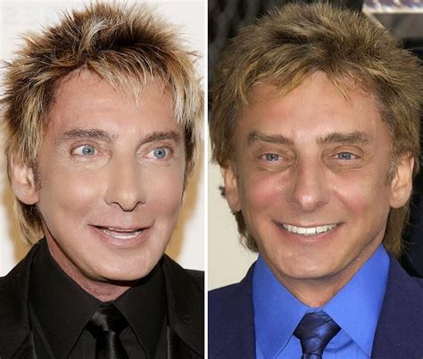 Barry Manilow Plastic Surgery Facelift, Nose Job Before and After Photos