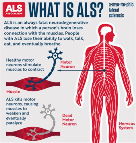 ALS (amyotrophic lateral sclerosis) Version 1.0 – Frequency Research Foundation