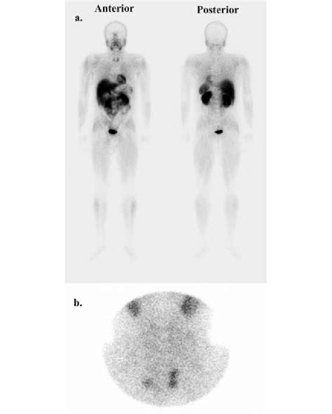 Preoperative 99m Tc-MIBI whole body scan (a) and neck pinhole image (b)... | Download Scientific ...