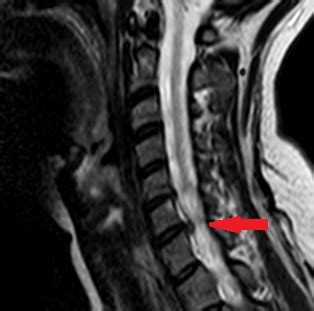 The Unintended Consequences of a Spine MRI - Shim Spine