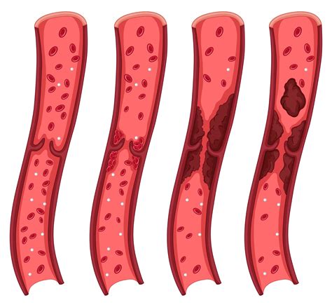 Blood clot diagram on white 418371 Vector Art at Vecteezy