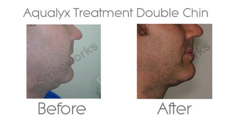 Aqualyx® Fat Dissolving | Review, prices, before and after & successes!