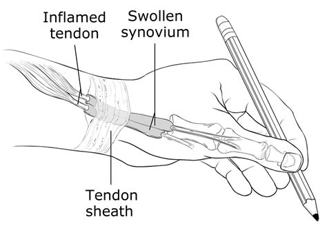 De Quervain’s Tenosynovitis - Causes, Symptoms, Test, Exercise, Surgery