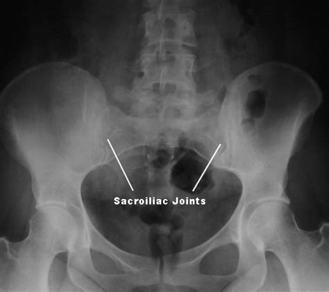 Sacroiliac Joint Syndrome -Redlands, Loma Linda, Highland | Bones and Spine Surgery Inc.