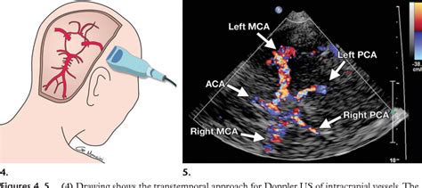 Transcranial Doppler Ultrasound