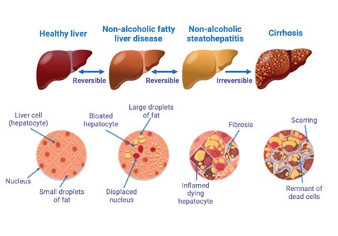 Uncovering the genetic causes of fatty liver disease