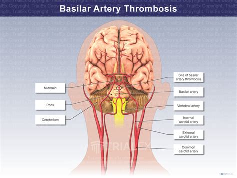 Basilar Artery Thrombosis - TrialQuest Inc.