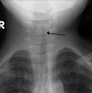 Bacterial Tracheitis - Respiratory - Medbullets Step 1